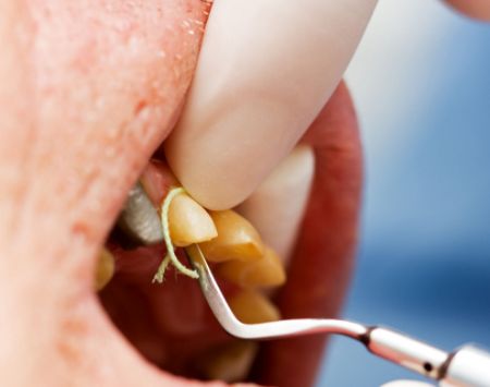 Picture for category Gingival Retraction