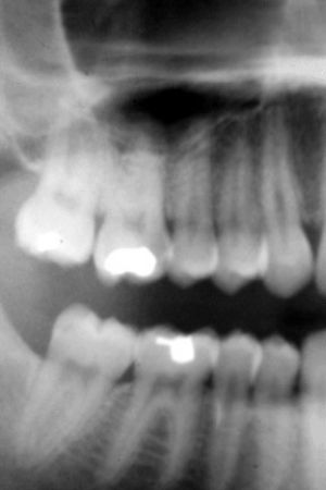 Picture for category X-Ray (Dental)