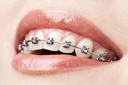 Picture for category Orthodontic Wire & Coils